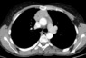 Axial and sagital reconstruction from a contrast enhanced chest CT at the level of the ascending aorta demonstrates an anterior medastinal mass. The mass shows a small regions of heterogeneity with a low attenuation region, and abuts the anterior aspect of the pericardium. There is a lobulated contour that abuts the lung . At surgery, the thymoma was found to invade the medaistinal fat as well as the right lung, without invasion into the aorta or other mediastinal vessels .